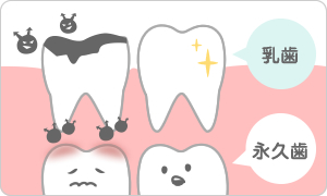 永久歯に影響する乳歯の虫歯